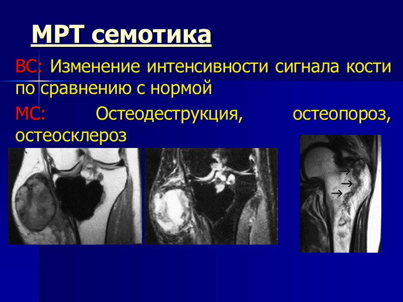 МРТ семотика ВС: Изменение интенсивности сигнала кости по сравнению с нормой МС: Остеодеструкция, остеопороз,